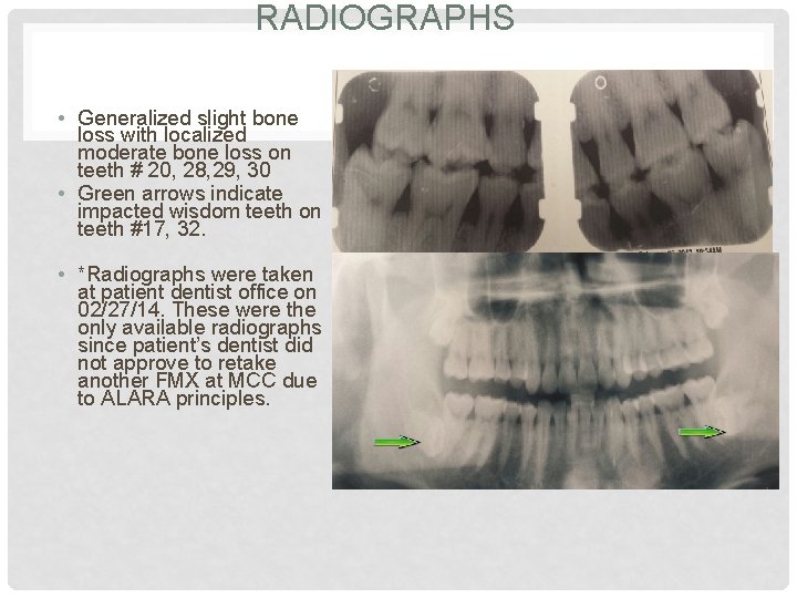 RADIOGRAPHS • Generalized slight bone loss with localized moderate bone loss on teeth #