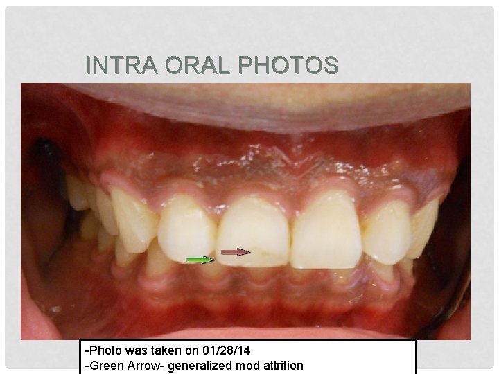 INTRA ORAL PHOTOS -Photo was taken on 01/28/14 -Green Arrow- generalized mod attrition 