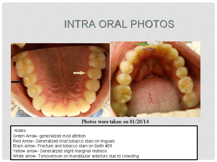 INTRA ORAL PHOTOS Photos were taken on 01/28/14 Notes: Green Arrow- generalized mod attrition