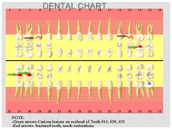 DENTAL CHART NOTE: -Green arrows-Carious lesions on occlusal of Teeth #14, #30, #31 -Red