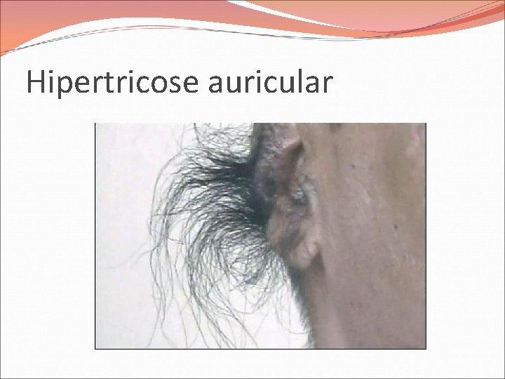 Hipertricose auricular 
