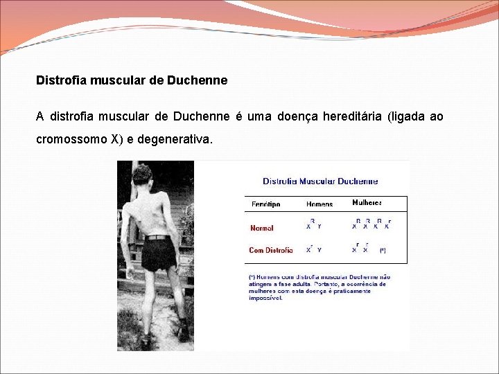 Distrofia muscular de Duchenne A distrofia muscular de Duchenne é uma doença hereditária (ligada