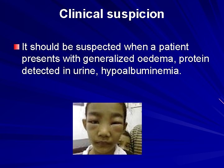 Clinical suspicion It should be suspected when a patient presents with generalized oedema, protein