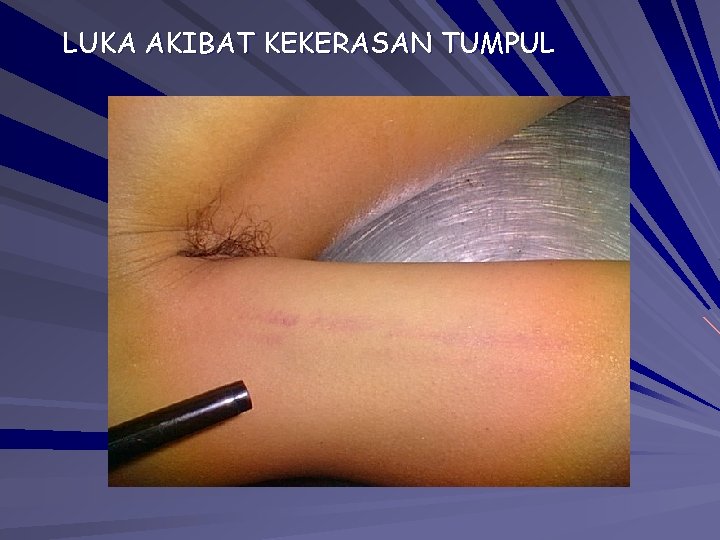 LUKA AKIBAT KEKERASAN TUMPUL LUKA AKIBAT KEKERASAN TUMPUL