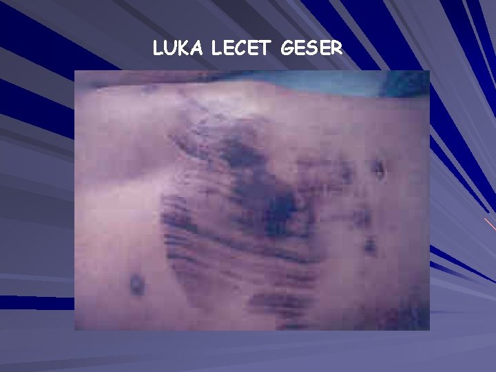 LUKA LECET GESER LUKA LECET GESER