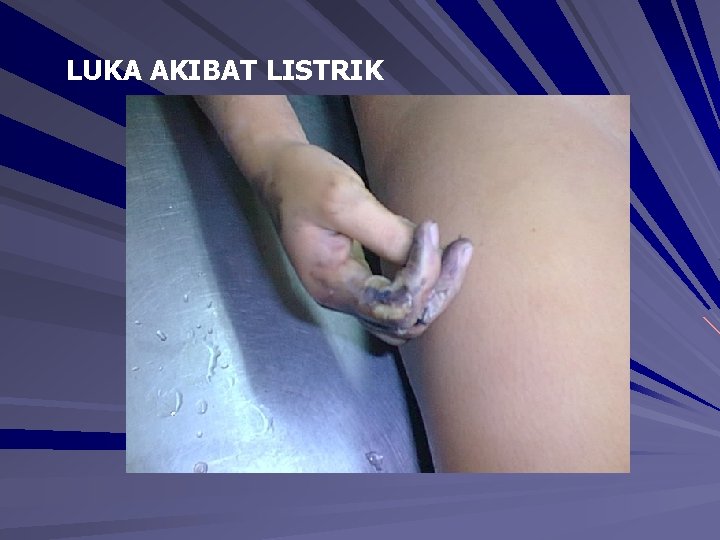 LUKA AKIBAT LISTRIK LUKA AKIBAT LISTRIK