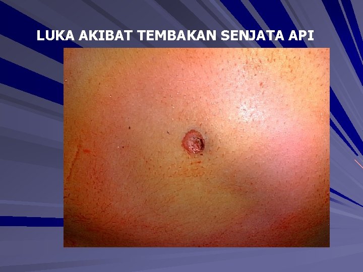 LUKA AKIBAT TEMBAKAN SENJATA API LUKA AKIBAT TEMBAKAN SENJATA API