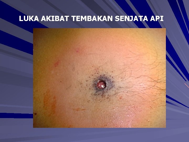 LUKA AKIBAT TEMBAKAN SENJATA API LUKA AKIBAT TEMBAKAN SENJATA API