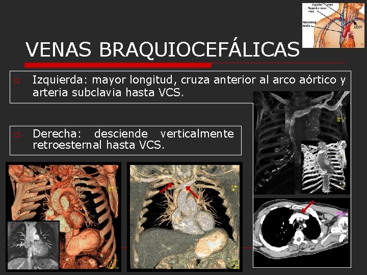 VENAS BRAQUIOCEFÁLICAS o o Izquierda: mayor longitud, cruza anterior al arco aórtico y arteria