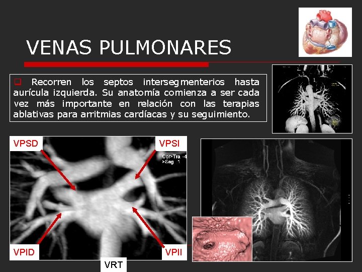 VENAS PULMONARES q Recorren los septos intersegmenterios hasta aurícula izquierda. Su anatomía comienza a