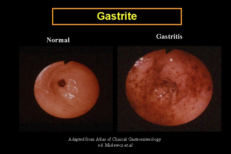 Gastrite Normal Gastritis Adapted from Atlas of Clinical Gastroenterology ed. Mislewcz et al 