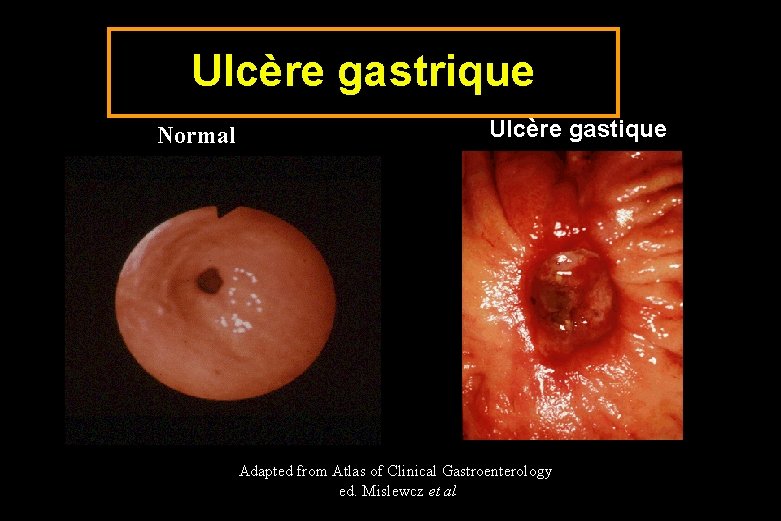 Ulcère gastrique Normal Ulcère gastique Adapted from Atlas of Clinical Gastroenterology ed. Mislewcz et
