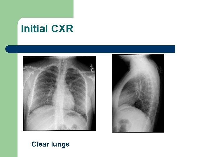 Initial CXR Clear lungs 