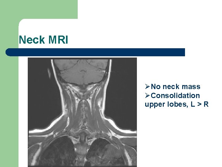 Neck MRI ØNo neck mass ØConsolidation upper lobes, L > R 