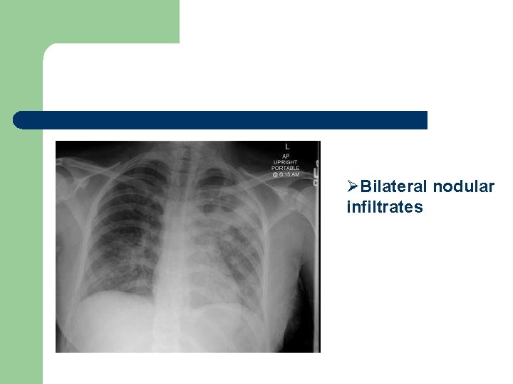 ØBilateral nodular infiltrates 