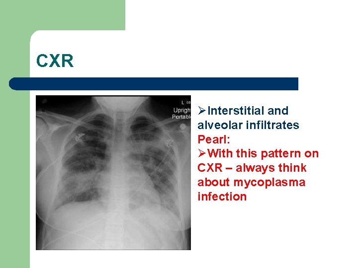 CXR ØInterstitial and alveolar infiltrates Pearl: ØWith this pattern on CXR – always think