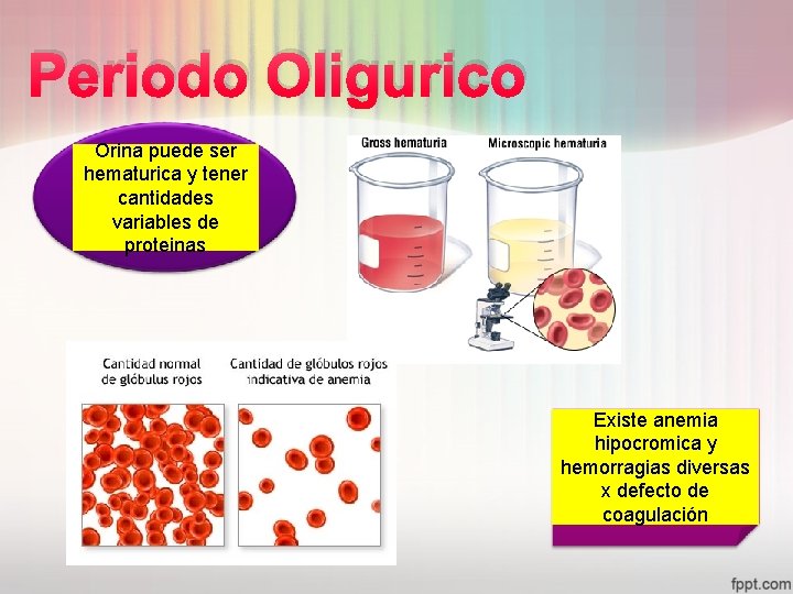 Periodo Oligurico Orina puede ser hematurica y tener cantidades variables de proteinas Existe anemia