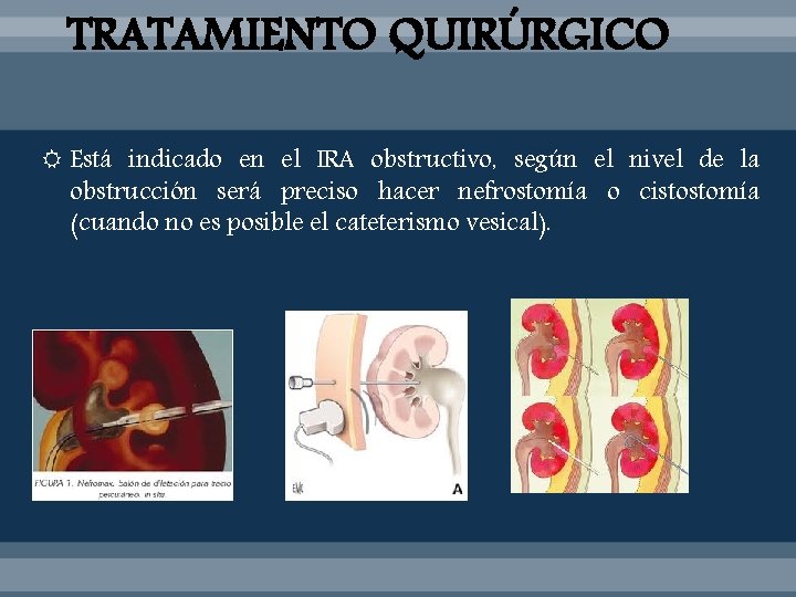 TRATAMIENTO QUIRÚRGICO Está indicado en el IRA obstructivo, según el nivel de la obstrucción