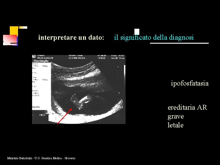 interpretare un dato: il significato della diagnosi ipofosfatasia ereditaria AR grave letale Maurizio Bartolozzi