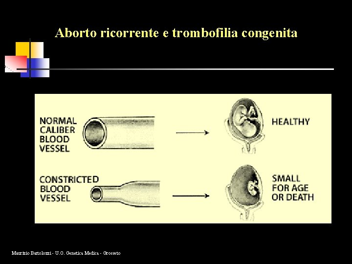 Aborto ricorrente e trombofilia congenita Maurizio Bartolozzi - U. O. Genetica Medica - Grosseto