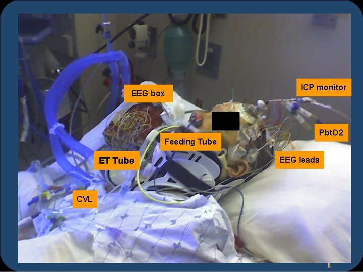 EEG box ICP monitor Pbt. O 2 Feeding Tube ET Tube CVL EEG leads