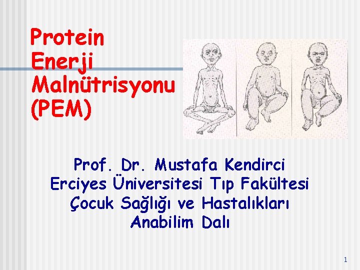Protein Enerji Malnütrisyonu (PEM) Prof. Dr. Mustafa Kendirci Erciyes Üniversitesi Tıp Fakültesi Çocuk Sağlığı
