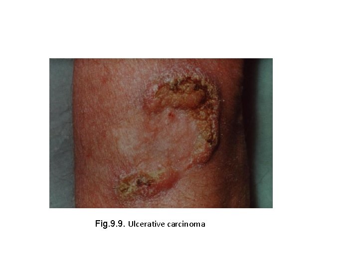 Fig. 9. 9. Ulcerative carcinoma 