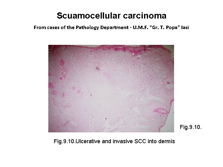 Scuamocellular carcinoma From cases of the Pathology Department - U. M. F. “Gr. T.