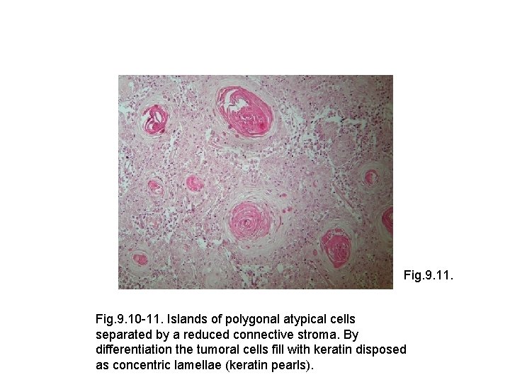 Fig. 9. 11. Fig. 9. 10 -11. Islands of polygonal atypical cells separated by