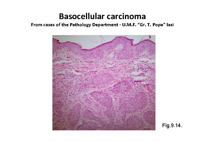 Basocellular carcinoma From cases of the Pathology Department - U. M. F. “Gr. T.
