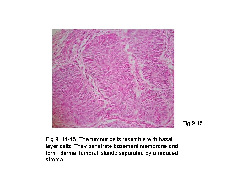 Fig. 9. 15. Fig. 9. 14 -15. The tumour cells resemble with basal layer