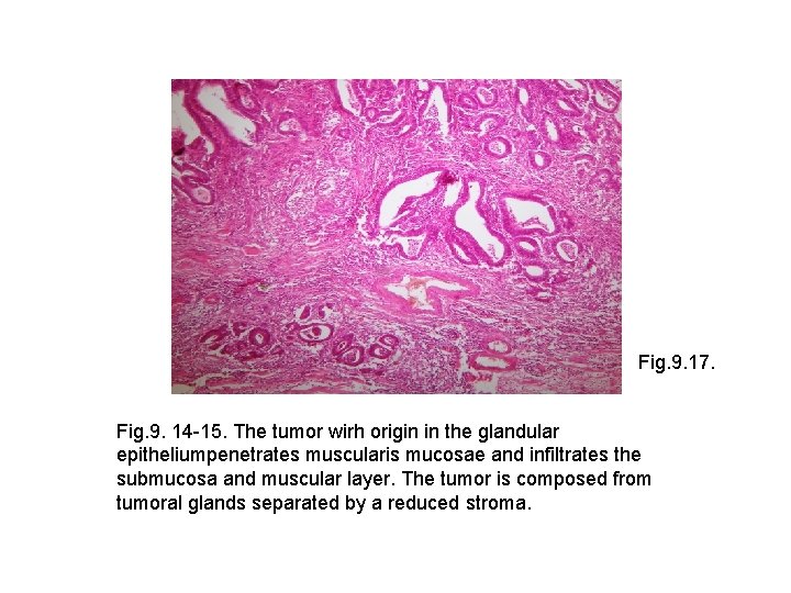 Fig. 9. 17. Fig. 9. 14 -15. The tumor wirh origin in the glandular