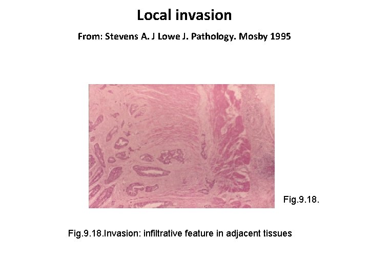 Local invasion From: Stevens A. J Lowe J. Pathology. Mosby 1995 Fig. 9. 18.