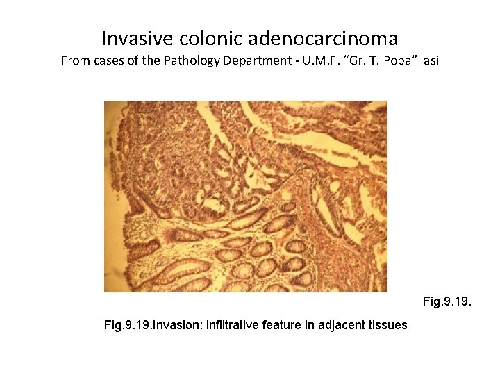 Invasive colonic adenocarcinoma From cases of the Pathology Department - U. M. F. “Gr.