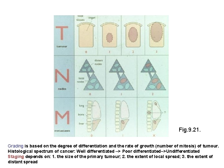 Fig. 9. 21. Grading is based on the degree of differentiation and the rate