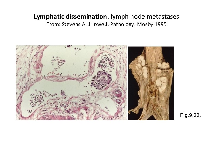 Lymphatic dissemination: lymph node metastases From: Stevens A. J Lowe J. Pathology. Mosby 1995