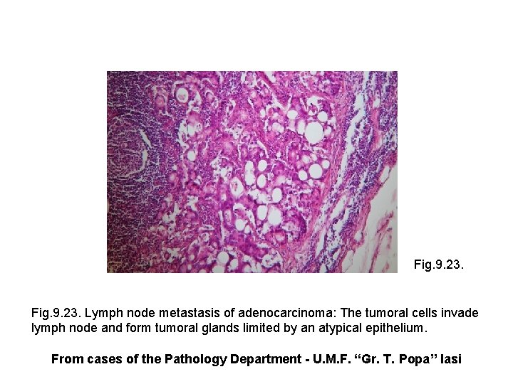 Fig. 9. 23. Lymph node metastasis of adenocarcinoma: The tumoral cells invade lymph node