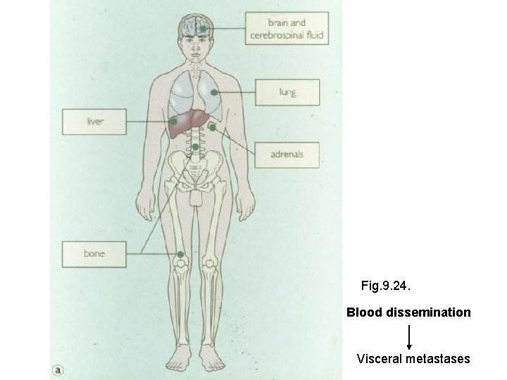 Fig. 9. 24. Blood dissemination Visceral metastases 