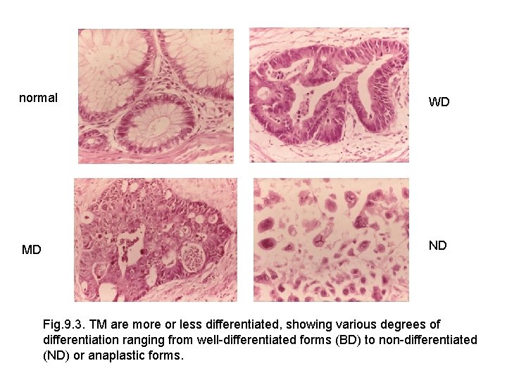 normal WD MD ND Fig. 9. 3. TM are more or less differentiated, showing