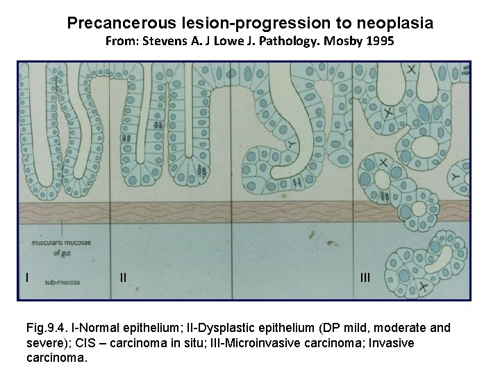 Precancerous lesion-progression to neoplasia From: Stevens A. J Lowe J. Pathology. Mosby 1995 I