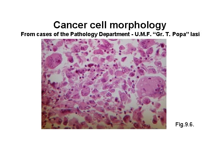 Cancer cell morphology From cases of the Pathology Department - U. M. F. “Gr.