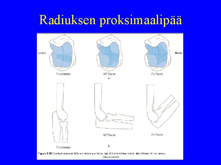 Radiuksen proksimaalipää 