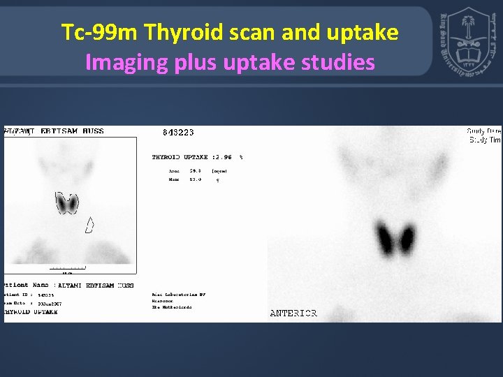 Tc-99 m Thyroid scan and uptake Imaging plus uptake studies 