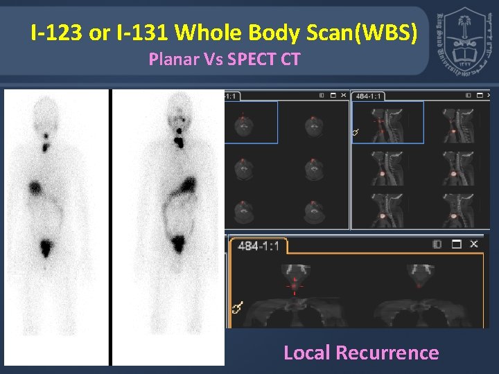 I-123 or I-131 Whole Body Scan(WBS) Planar Vs SPECT CT Local Recurrence 