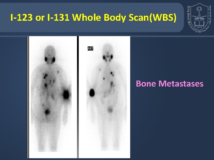 I-123 or I-131 Whole Body Scan(WBS) Bone Metastases 