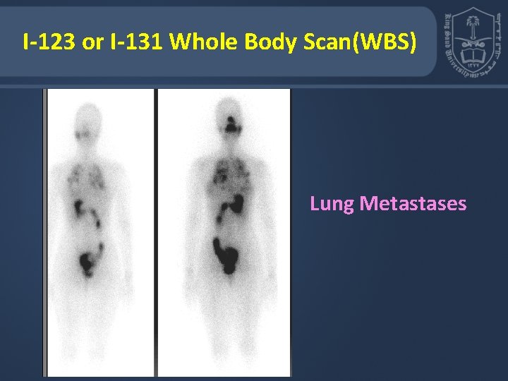 I-123 or I-131 Whole Body Scan(WBS) Lung Metastases 