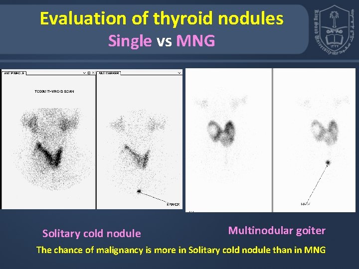 Evaluation of thyroid nodules Single vs MNG Solitary cold nodule Multinodular goiter The chance