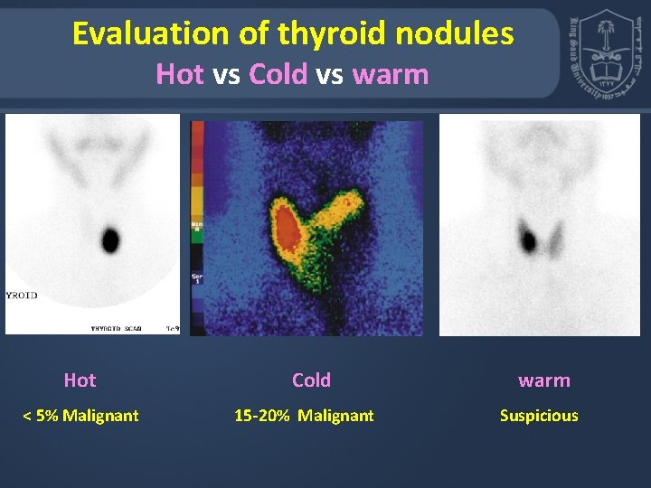 Evaluation of thyroid nodules Hot vs Cold vs warm Hot Cold warm < 5%