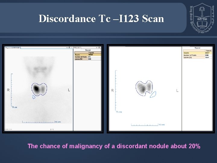 Discordance Tc –I 123 Scan The chance of malignancy of a discordant nodule about