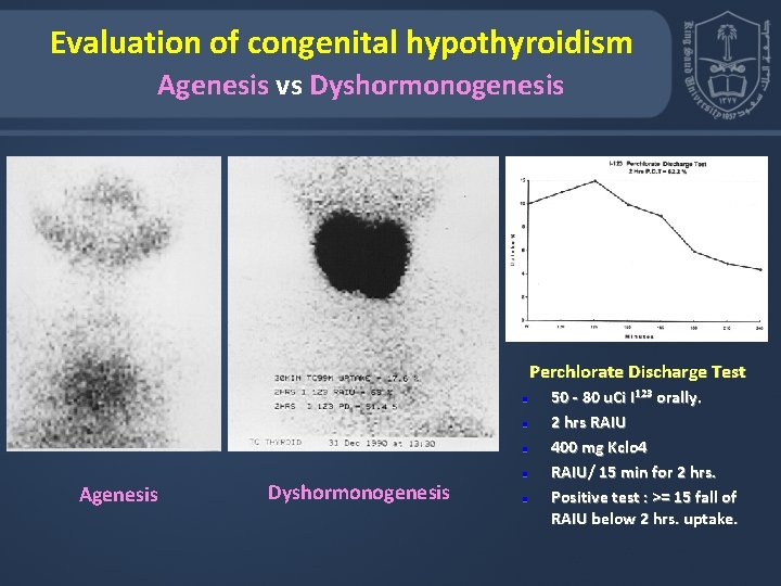 Evaluation of congenital hypothyroidism Agenesis vs Dyshormonogenesis Agenesis Dyshormonogenesis Perchlorate Discharge Test n 50